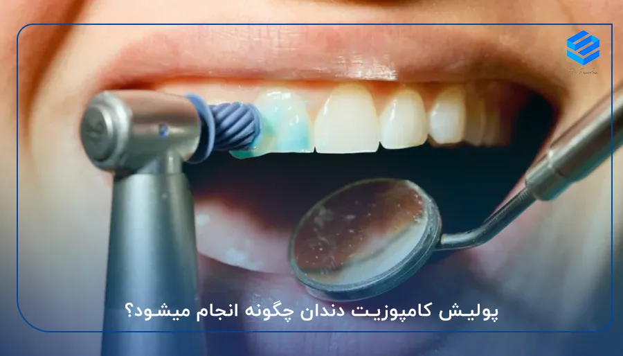 پولیش کامپوزیت دندان چگنه انجام میشود؟