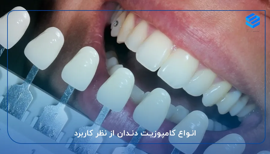 انواع کامپوزیت دندان از نظر کاربرد