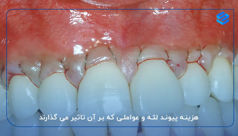 هزینه پیوند لثه و عواملی که بر آن تاثیر می گذارند