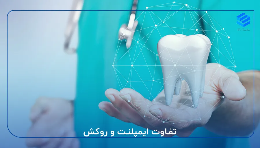 تفاوت ایمپلنت و روکش