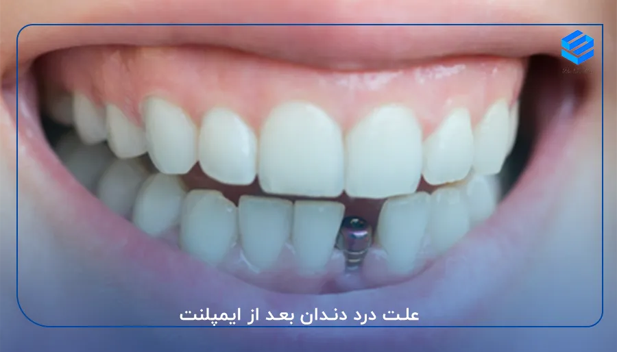 علت درد دندان بعد از ایمپلنت