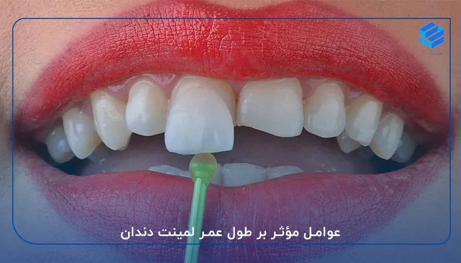 عوامل مؤثر بر طول عمر لمینت دندان
