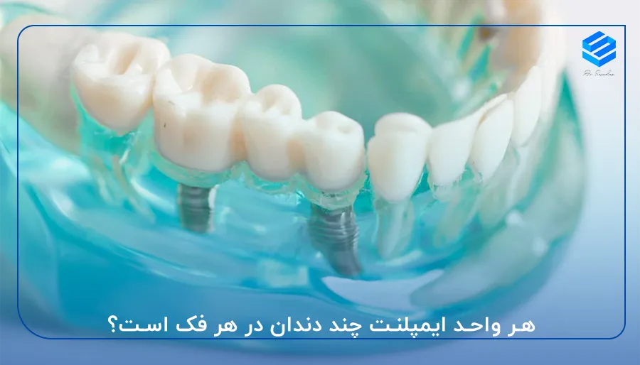 هر واحد ایمپلنت چند دندان در هر فک است