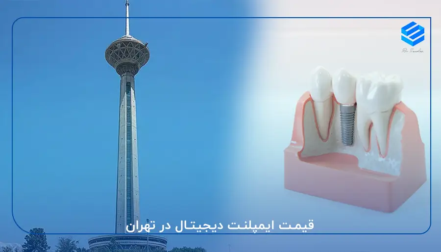 قیمت ایمپلنت دیجیتال در تهران